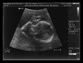 16-02-06 20 weken echo scan 2